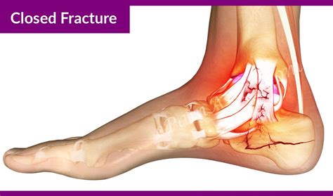 Pin by Anja Stephan on Foot Dr. | Calcaneus fracture, Treatment recovery, Fractures