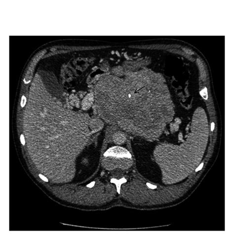 Giant insulinoma: an unusual cause of hypoglycaemia | BMJ Case Reports