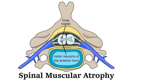 Spinal Muscular Atrophy: Definition, 3 Types, Symptoms, And Treatment ...