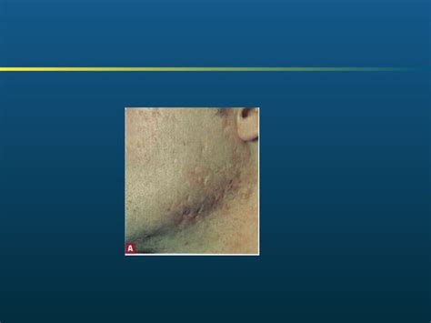 Pilosebaceous Disorders including Acne vulgaris | PPT