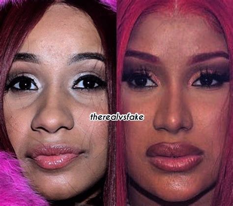 Cardi B: Before & After Nose Job & Fillers | Nose job, Rhinoplasty nose ...