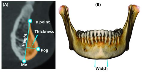 Measurements of the chin. (A) Height, thickness, and cross-sectional... | Download Scientific ...