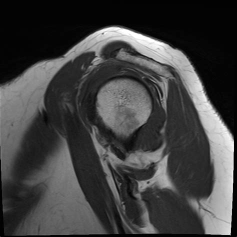 Subacromial impingement | Image | Radiopaedia.org