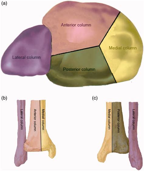 Schematic layout of four-column classification of tibial plafond. (a)... | Download Scientific ...