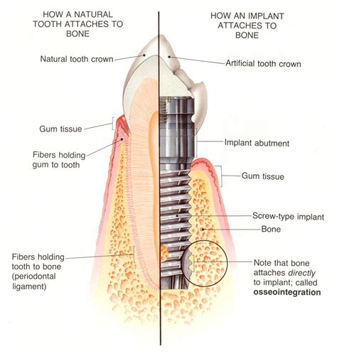 Osseointegration And Dental Implants: A Comprehensive Guide