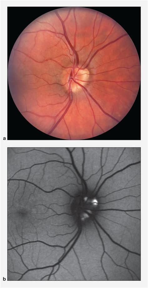 Imaging of optic nerve drusen - American Academy of Ophthalmology