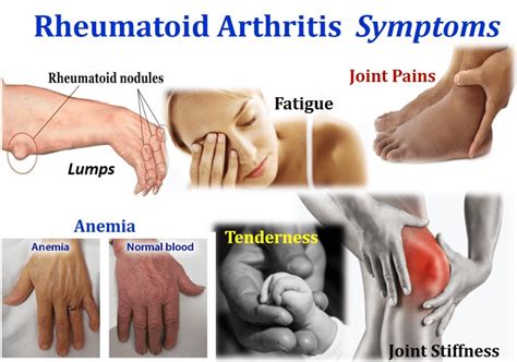 Arthritis: 7 most painful types of arthritis- cause, symptoms, treatments