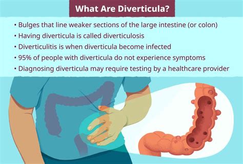 Diverticulosis - MEDizzy