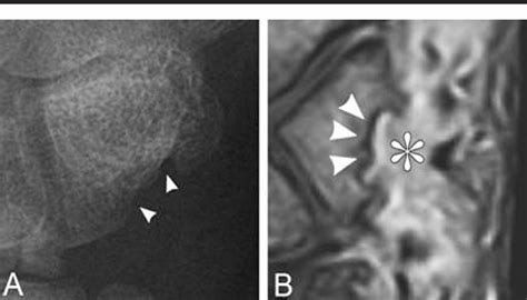 Imaging of tophi with an extremity-dedicated MRI system. | Semantic Scholar