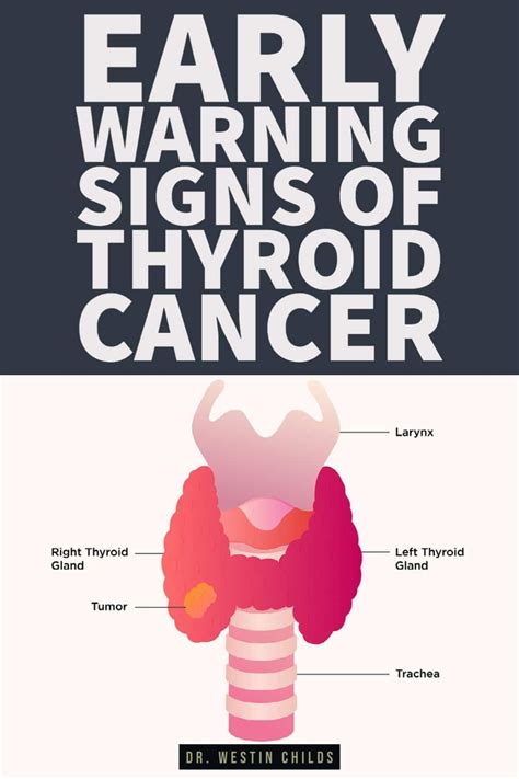 Thyroid cancer symptoms early warning signs – Artofit