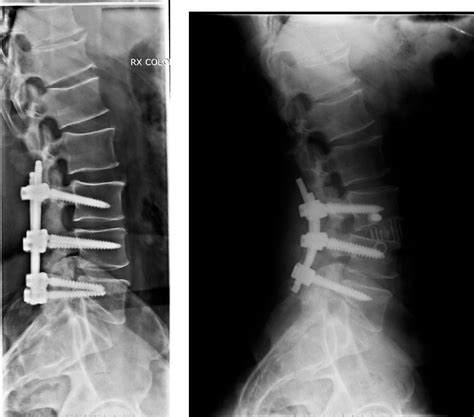 Lumbar Lordosis Correction With Interbody Hyperlordotic Cages: Initial Experience, Learning ...