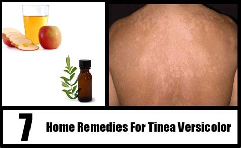 7 Tinea Versicolor Home Remedies, Natural TreatmentsAnd Cure | Search ...