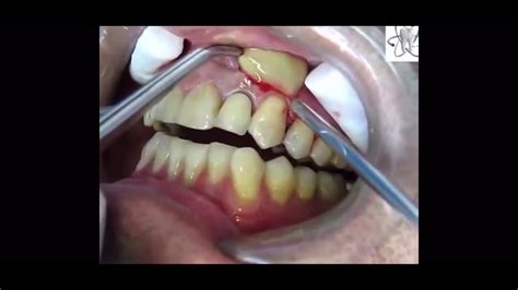 Upper Buccal Abscess Incision & Drainage - YouTube