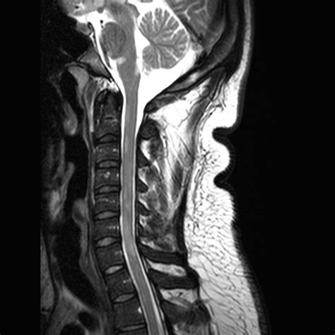 Diagnosing Multiple Sclerosis With MRI | AffordableMRI.com