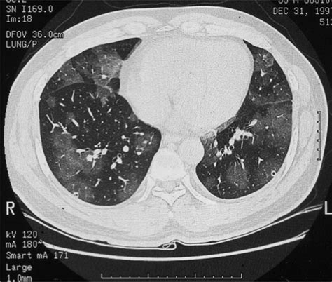 Lung CT showing multifocal ground-glass opacities in bo | Open-i