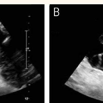 A & B: Ultrasound scans of a patient with a complete hydatidiform mole ...