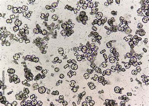 Microscopic image showing calcium oxalate monohydrate, uric acid ...