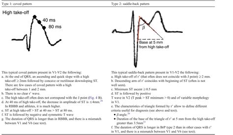 emDOCs.net – Emergency Medicine EducationBrugada Diagnostic Criteria - emDOCs.net - Emergency ...