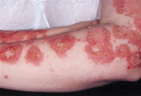 Frequency and Severity of Systemic Disease in Patients With Subacute Cutaneous Lupus ...