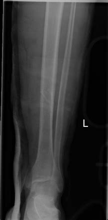 Oblique Fracture