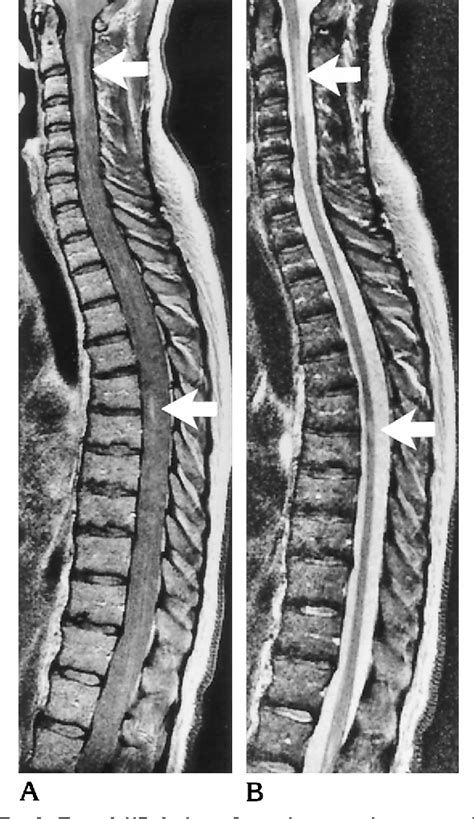 Figure 2 from MR of the spinal cord in multiple sclerosis: relation to clinical subtype and ...