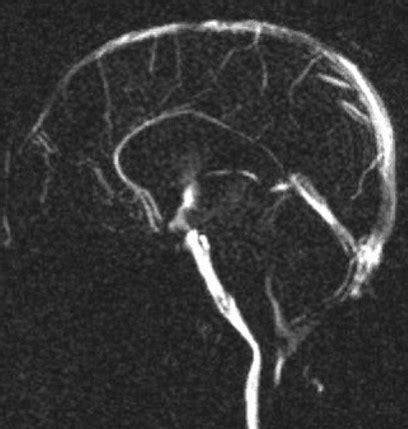 Ventriculostomy Drain Mri Safe - Best Drain Photos Primagem.Org