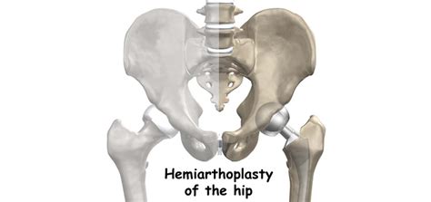 Bipolar Hemiarthroplasty