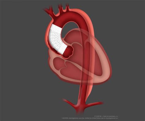 Gore Announces Successful Patient Implant of Endovascular Stent Graft for the Ascending Aorta | Gore