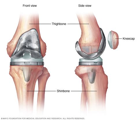 Knee replacement - Mayo Clinic