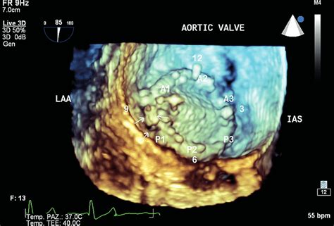 3D echo exam showing the extent of the mitral valve leakage | Download ...