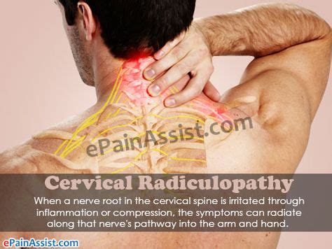 12 Cervical Radiculopathy ideas | radiculopathy, cervical radiculopathy, cervical