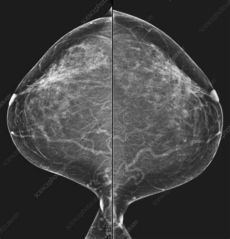 Normal fibroglandular densities, mammogram - Stock Image - C039/3390 - Science Photo Library