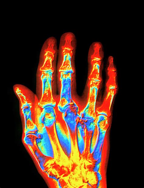 Coloured X-ray Of A Gout Sufferer's Hand Photograph by Alfred Pasieka ...