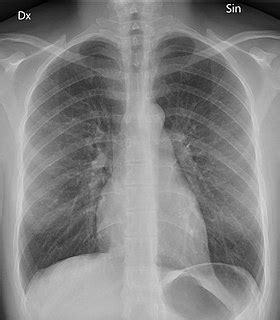 Chest radiograph - Wikipedia