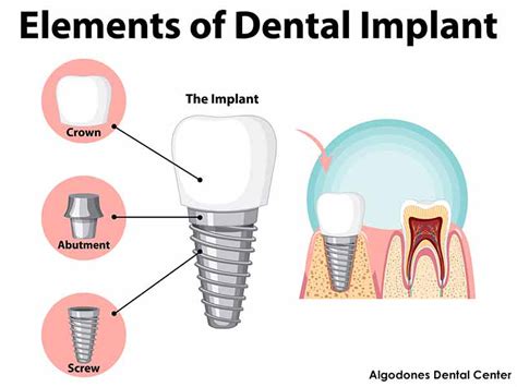 Dental Implants in Los Algodones | Save Big on Quality Treatment