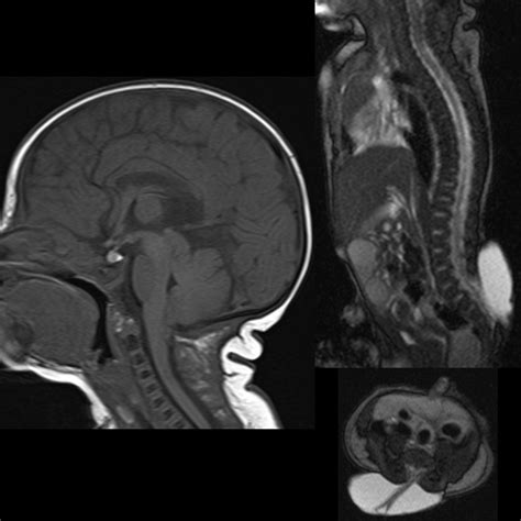 Chiari II Malformation | Pediatric Radiology Reference Article | Pediatric Imaging | @pedsimaging