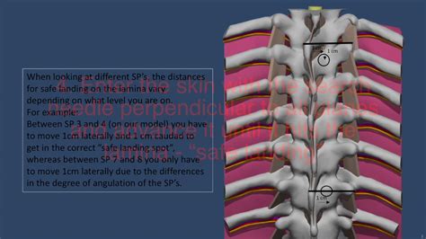 Landmark Based Thoracic Epidural - YouTube