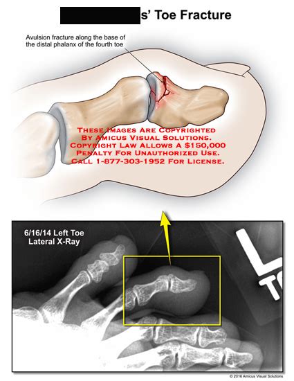 AMICUS Illustration of amicus,injury,radiology,x-ray,toe,fracture,avulsion,base,distal,phalanx