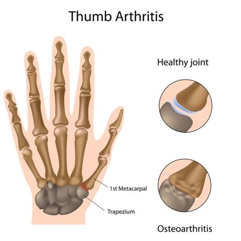 Osteoarthritis of the thumb - 1st CMC thumb - Ultrasound Guided Injections