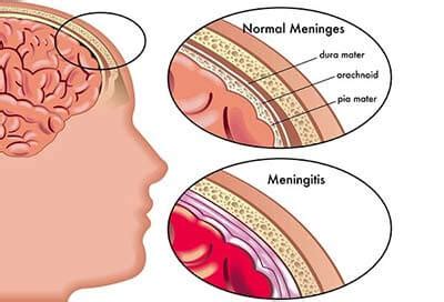 Meningitis | Head, Neck - Pain Doctors Brooklyn NYC