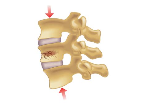 Compression Fracture