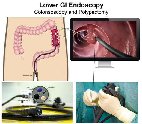 Lower Endoscopy Procedure