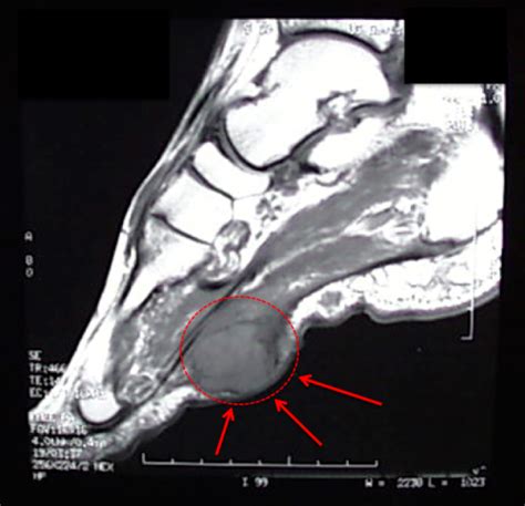 Plantar Fibroma - FootEducation