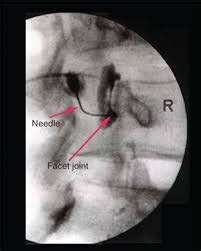 Lumbar Facet Injections Austin, TX — Austin Spine Health