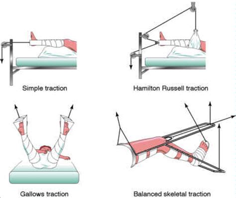 Traction types | Pediatric nursing, Nursing mnemonics, Medical surgical nursing