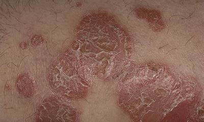 Plaque psoriasis symptoms pictures, what does plaque psoriasis look ...