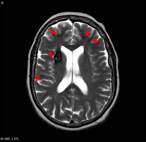 Cavernous Malformation - Cause, Brain Stem Symptoms, Treatment