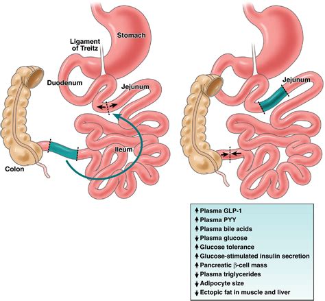 Alas! Ileal Interposition Surgery for Diabetes Prevention? - Gastroenterology