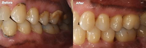 Dental Images Before and After in Indianapolis, IN | Sonrisa Dental