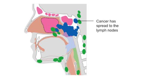 Nasopharyngeal Cancer